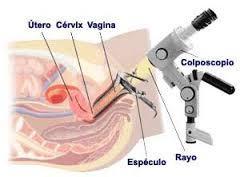 Colposcopia