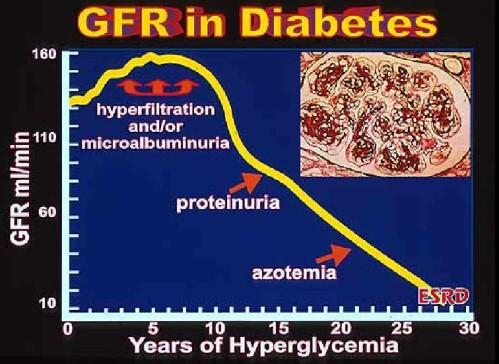 STORIA NATURALE DELLA ND Dopo 10-15 anni dalla diagnosi 20-40% dei Diabetici tipo 1 e 2 presenta