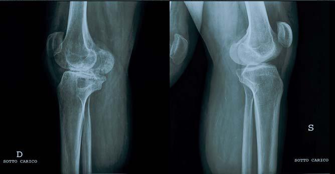 Osteoporosi Diminuzione