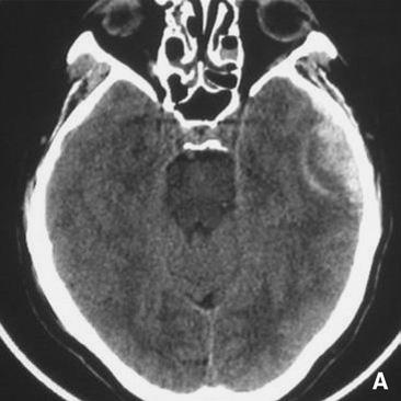 Ematomi intracranici post-traumatici in fase acuta I 17-585-A-20 Figura 8. Ematoma intracerebrale temporale sinistro in 1 a (A), 2 a (B) e 6 a giornata (C).