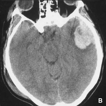 Esami complementari Tomografia computerizzata Prima dell era della TC cerebrale, l EICT era diagnosticato raramente.