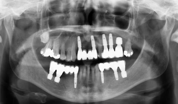 Radiografia panoramica dopo due anni.