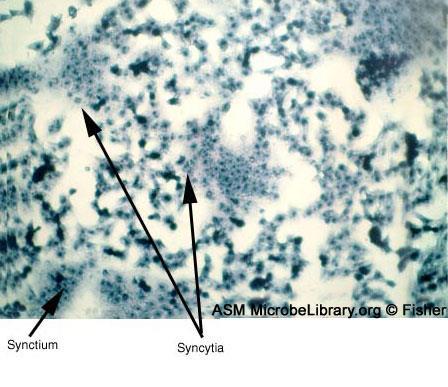 Citomegalia Virus del morbillo.