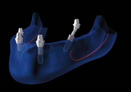 b) Abutment easy-on-four angolati: utilizzando l apposito driver esagonale 1,27, avvitare gli abutment all