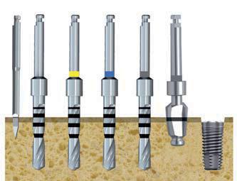 CORE V2 Ø 4.2 * 1 2 3 4 5 Legenda: 1 fresa iniziale 2 fresa Ø 2 mm 3 fresa Ø 3 mm 4 5 6 inserimento impianto 6 N.B.: All occorrenza utilizzare il maschiatore 1 2 3 4 5 CORE V2 Ø 4.