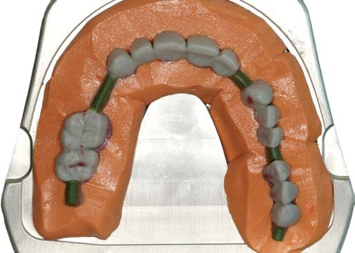 autologo f La chirurgia ricostruttiva dei tessuti duri f La chirurgia ricostruttiva dei tessuti molli f Fallimenti dei tessuti molli in terapia implantare f