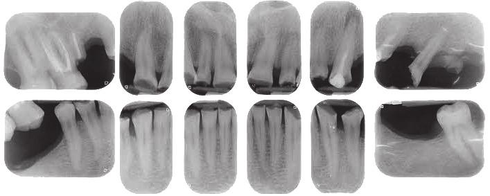 cementi f Cementazione adesiva f Tecniche di cementazione f Cementazione di metalli zirconio f La