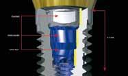 T3 Implant Il primo ibrido trifunzionale con superficie nanotecnologica DCD T1 Tecnologia Bone Superficie nanotecnologica per una osteointegrazione ottimizzata Valore medio complessivo: Sa 1,2 μm