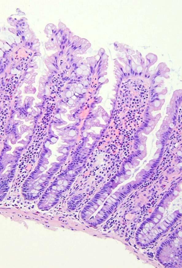 HP Caratteristiche istologiche Ghiandole regolari non ramificate che si dilatano progressivamente verso la superficie Compartimento proliferativo, cellule immature e mitosi nella porzione basale