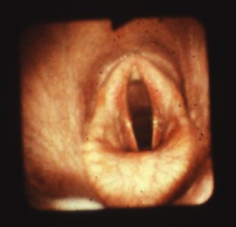 Patologia: corneggio laringeo (Emiplagia a carico del laringe)