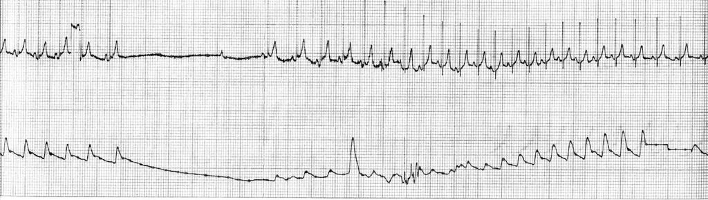 Massaggio del seno carotideo Indicato nei pazienti con età > 40 anni con sincope di incerta eziologia E diagnostico se riproduce