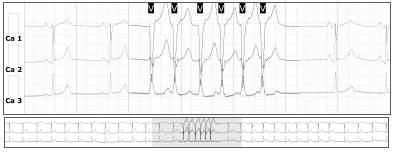 Caso clinico Donna 40 anni Familiarità per patologie cardiache Vertigini Viene visitata dall otorino il quale non rilevando nulla di patologico consiglia visita cardiologica.