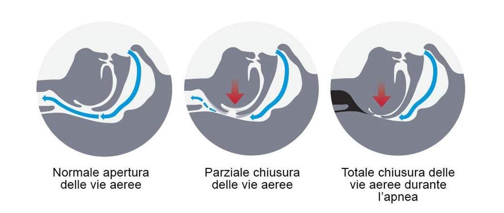 COMPLICANZE Ipertensione arteriosa sistemica Ipertensione polmonare Aritmie Insufficienza