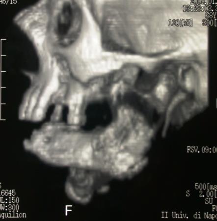 Uncovering the Cause of Phossy Jaw Circa 1858 to 1906: Oral and Maxillofacial