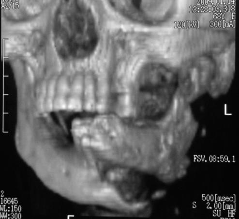 J Oral Maxillofac Surg; 66:2356-2363, 2008 Hellstein and Marek.