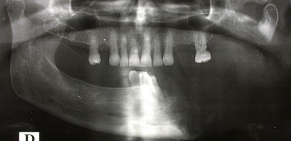 21st Century? J Oral Maxillofac Surg;63:682-689, 2005 Donoghue.