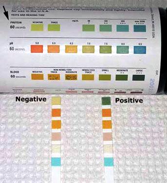 Proteinuria: per rivelarla DIPSTICK Test: E l esame più usato per rivelare livelli anormali di proteine nelle urine Rivela valori di proteinuria >20