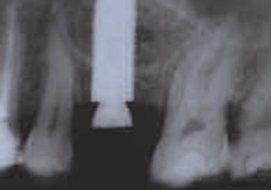 cresta alveolare. L esame radiografico evidenziava nel gruppo di test uno scarso riassorbimento osseo che non superava mai 0,8 ± 0,3 mm nei 24 mesi di osservazione con un range 0-1,2 (Fig.