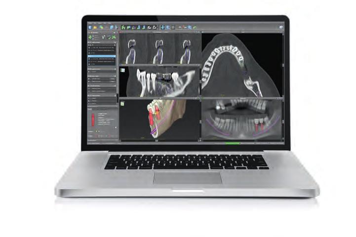 Esiste inoltre la possibilità di una pianificazione digitale con codiagnostix Questo software di pianificazione implantare e diagnostica in 3D è studiato per la pianificazione chirurgica di impianti