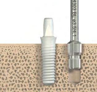 1 4.3 Preparazione avanzata del letto implantare La preparazione avanzata del letto implantare prevede l utilizzo della fresa svasata e la successiva maschiatura.