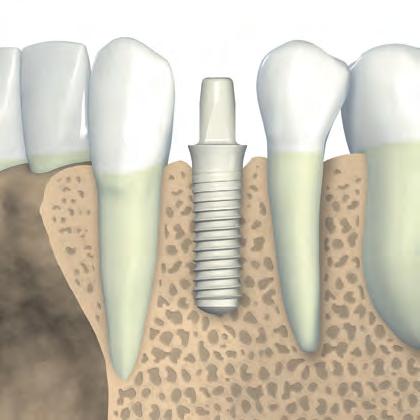 Diametro della spalla D [mm] 1.5 mm Larghezza min del gap [mm] Distanza tra i denti a livello osseo b min [mm] 3,5 (ND) 5,5 6,5 4,8 (RD) 7 8 b a D 1.