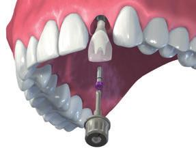 4.1.5 Inserimento (presso lo studio dentistico) Componenti secondarie Straumann CARES Procedura protesica Preparazione Togliere la cappetta di guarigione o restauro provvisorio.