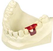 4.2.4 Utilizzo di ausili di transfer per protesi di dente singolo Per garantire il corretto trasferimento della posizione della componente secondaria dal modello master al paziente, è possibile