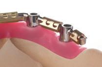 4.3.2 Barre CARES Uso previsto Le barre Straumann CARES per protesi fisse sono sovrastrutture da applicare direttamente con resina dentale e denti prefabbricati in resina, indicate nei casi di