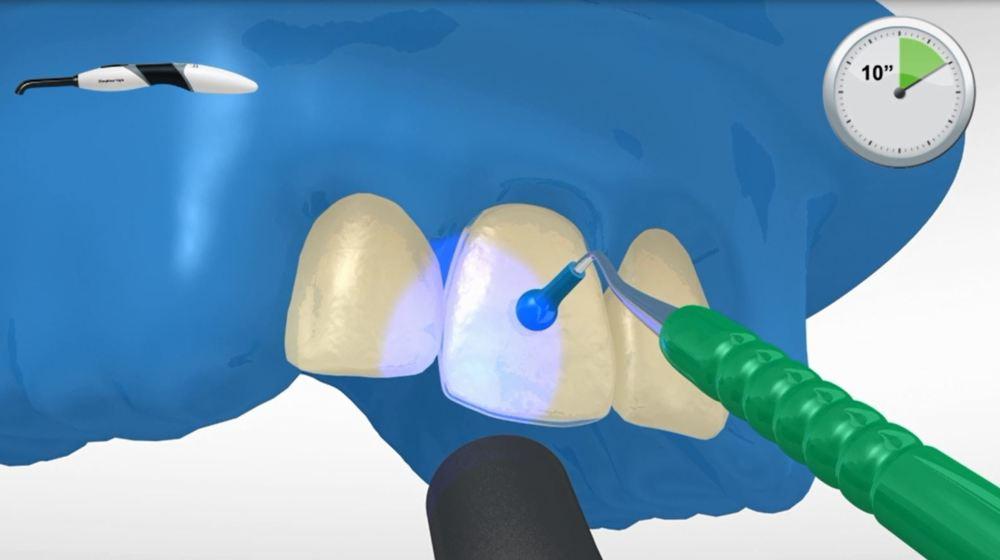 Variolink Esthetic, come tutti i compositi, è soggetto ad inibizione da ossigeno.