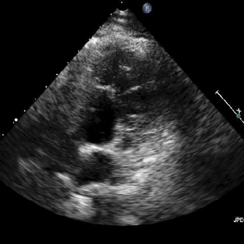 TGA congenitamente corretta Relazione fra le grandi arterie Sezione