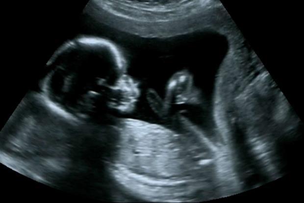 L immagine di un bambino non ancora nato scatena meraviglia e affetto in rete. E suscita un dubbio: chi tutela la sua privacy? Dunque quel feto ha dei diritti: ad iniziare da quello alla vita.