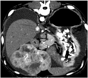 22 mg/dl 1-96 mg/dl 85-286 ng/ml 95-226 mcg/ml 103 Sarcoma istiocitico (ex