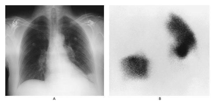 Sokolove, P. E. et al. N Engl J Med 2001;345:1311 The chest radiograph demonstrated a pleural-based, wedge-shaped pulmonary infarction (Hampton's hump) at the left lung base (Panel A).