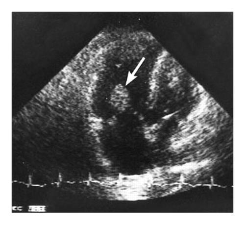 Echocardiography revealed a large thrombus floating in the right atrium that