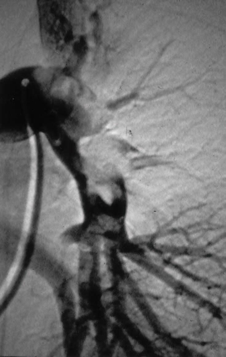 Diagnosi: Angiografia polmonare GOLD STANDARD per la diagnosi di embolia polmonare prevede l introduzione nell albero arterioso polmonare di mezzo di contrasto dimostrando segni diretti: completa