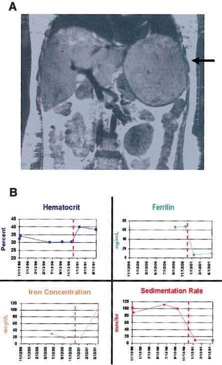 L anemia da infiammazione cronica!