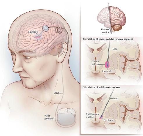 DBS: stimolazione