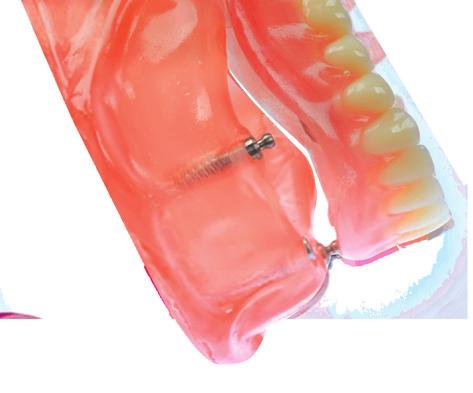 FlexiNylon infrangibile è un nuovo materiale termoplastico per protesi flessibili.
