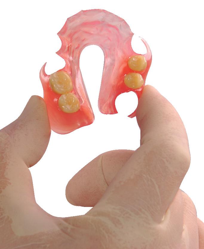 Un nuovo concetto di protesi flessibili T-Crystal over-denture su impianti T-Crystal