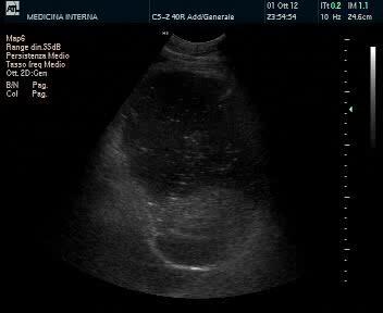 Gastrectasia Scansione laterale