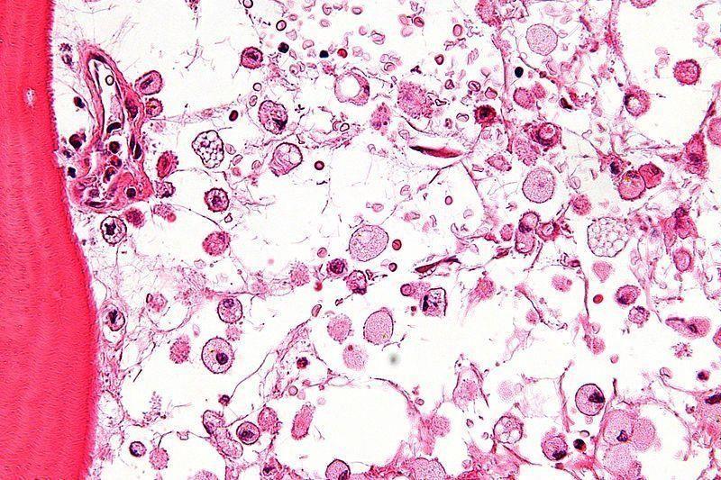 MALATTIA DA ACCUMULO LISOSOMIALE Lysosomal Storage Diseases(LSD) La classificazione delle malattie da accumulo lisosomiale è molto diversificata a seconda degli approcci descrittivi usati.