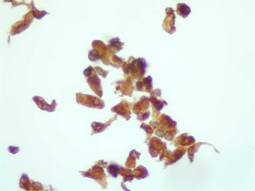 Immunocitochimica Carcinoma midollare?