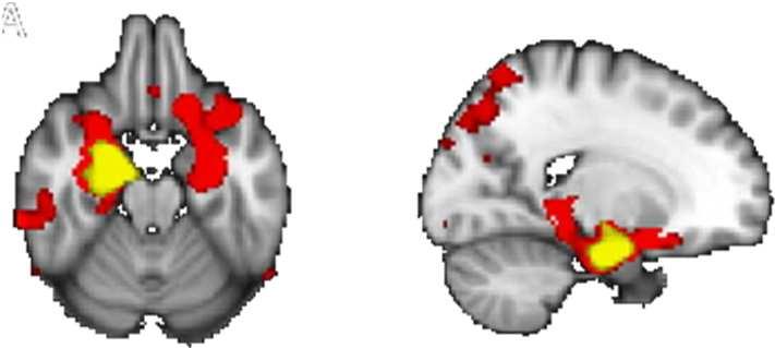 MRI strutturale (T1-W) nella malattia di Alzheimer AD preclinico 5-10 anni prima del