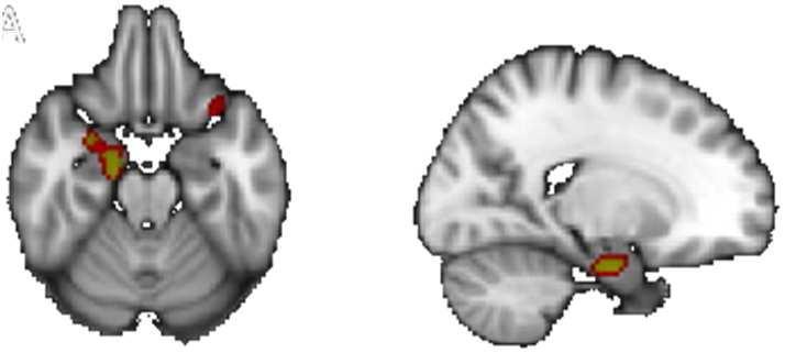 progressione di AD Le alterazioni strutturali che si osservano nell AD preclicnico interessano