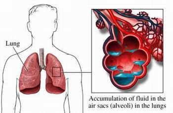 TALE SERIE DI EVENTI SI MANIFESTA PRIMARIAMENTE NEI POLMONI DETERMINANDO IL VERIFICARSI DELLA: ARDS SINDROME DA DISTRESS RESPIRATORIO CHE RISULTA ESSERE FREQUENTEMENTE L ESORDIO DELLA: MOF Multiple