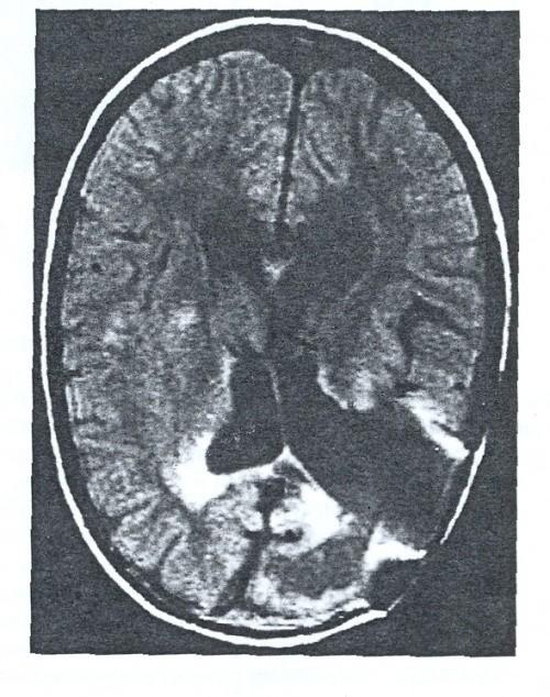 Spettroscopia NMR (in vivo) Magnetic Resonance Imaging MRI Un solo segnale (1H MRI: