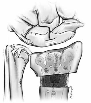 TFCC. D) Dopo aver eseguito una osteotomia correttiva del radio distale una artroscopia di polso consente di valutare la tensione del complesso TFCC e di eseguire un eventuale