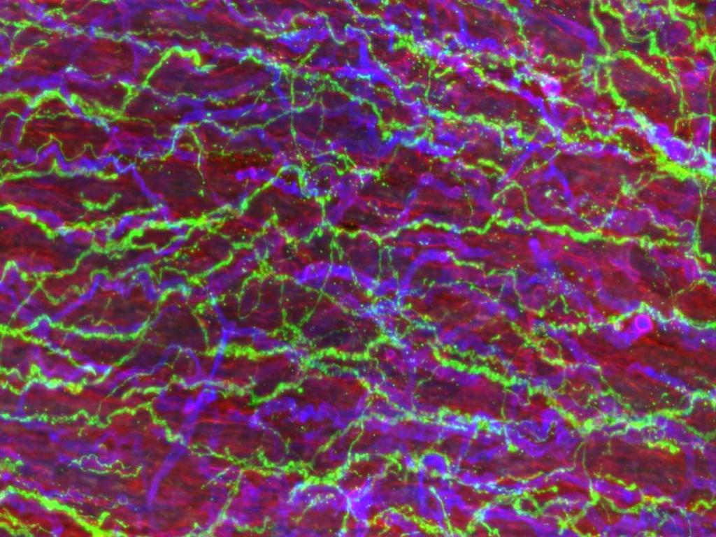 5 (marker for peripheral nerve fibers of all types) Coll- IV= Collagen