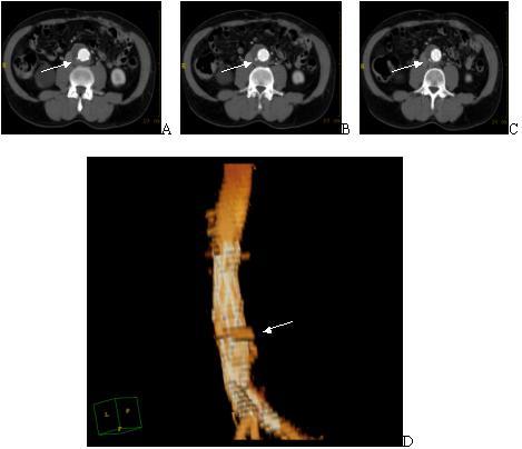 Complicazioni Post intervento ENDOLEAK TIPO II EL II Endoleak Tipo II (EL II): è il più comune, deriva dalla perfusione della sacca aneurismatica residua dell AAA dalle arterie che normalmente