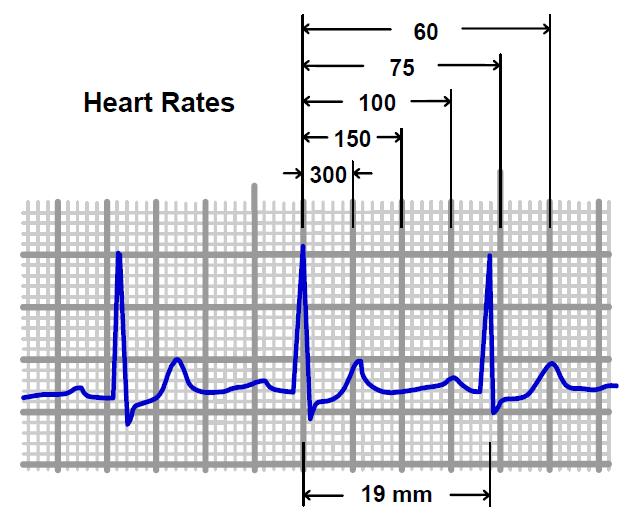 La Frequenza cardiaca Misurarla senza cardiofrequenzimetro Fc > 50 bpm spostandosi di 5 mm in 5 mm da una prima onda R possiamo marcare le seguenti frequenze decrescenti 300 150 100 75 60 50 la Fc
